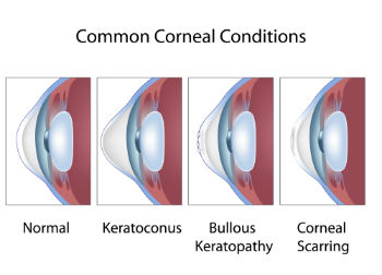 Common Cornea Conditions