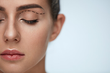 Woman before Ptosis Repair
