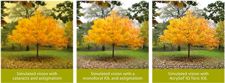 Cataracts correction with various intraocular lenses