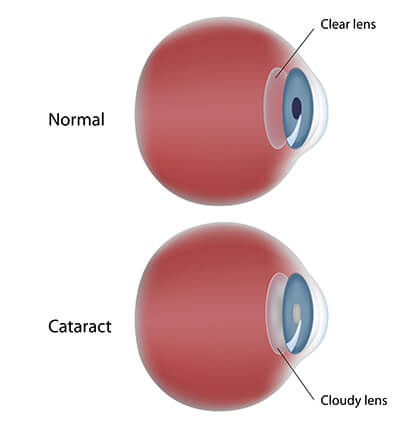 Cataracts Comparison Diagram 
