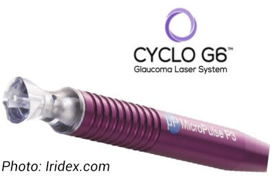The Cyclo G6 Glaucoma Treatment
