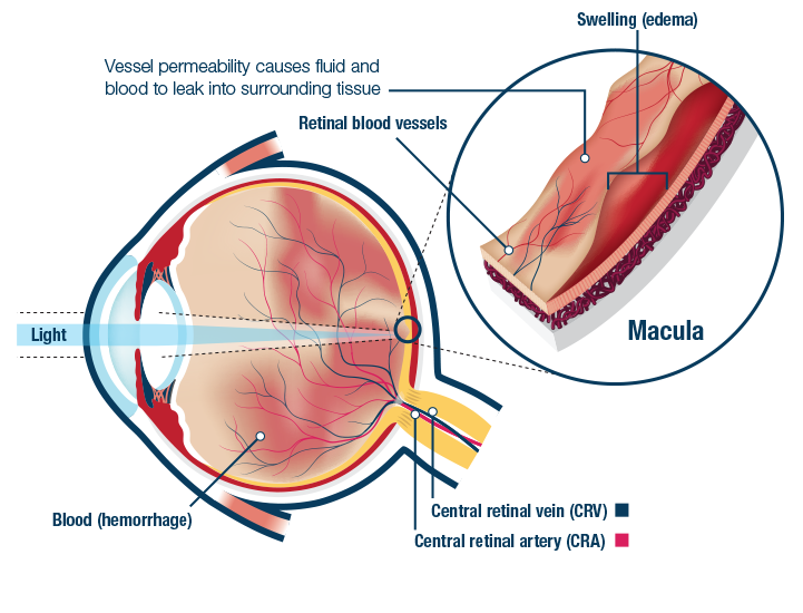 Diabetic Macular Edema