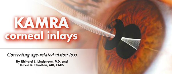 KAMRA corneal inlay Correcting age-related vision loss