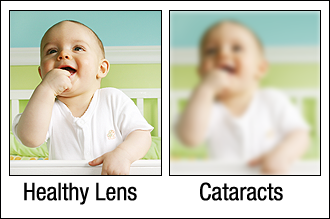 Chart showing what it's like seeing with a cataract