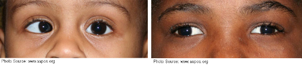 Strabismus in a child