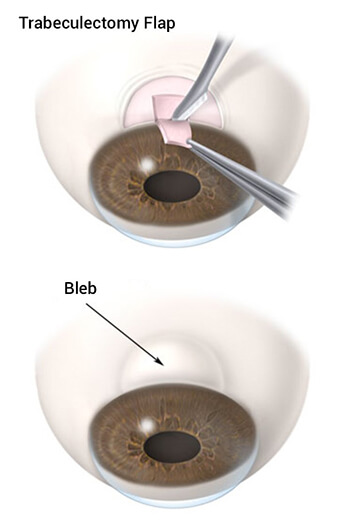Trabeculectomy Flap