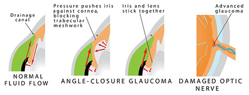 Chart showing an eye with angle closure glaucoma
