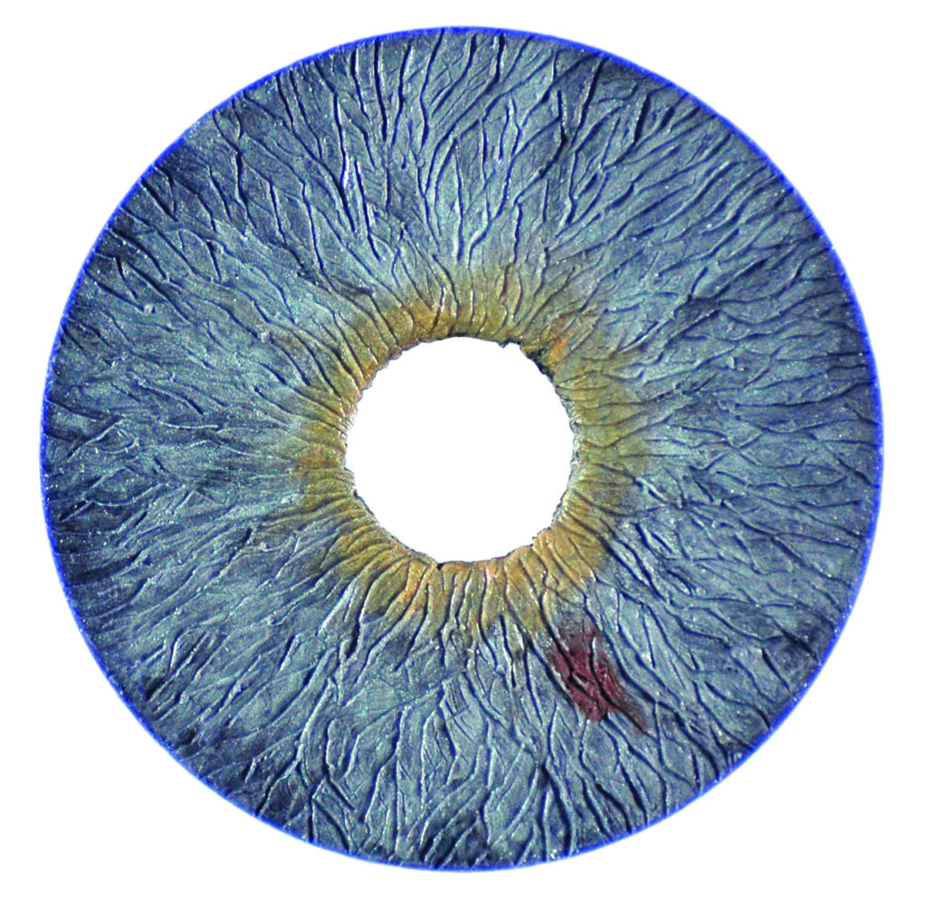 Now FDA Approved The CustomFlex® Artificial Iris Minnesota Eye