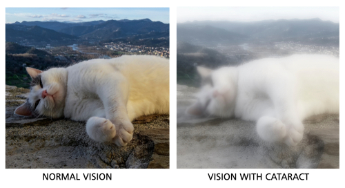 Normal Vision vs Vision with a Cataract