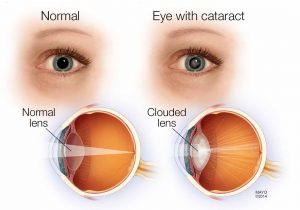 Cataracts Diagram