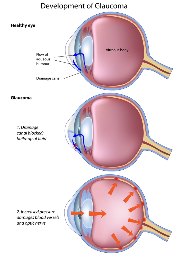 Glaucoma Diagram