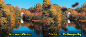 comparison of normal vision and vision with diabetic retinopathy
