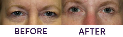 4-Eyelid Blepharoplasty & Internal Brow Lift