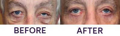 4 Eyelid Blepharoplasty