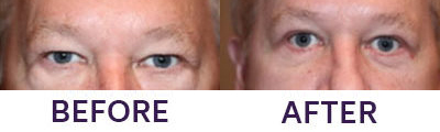 4 Eyelid Blepharoplasty