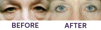 4 Eyelid Blepharoplasty