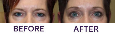 Endoscopic Brow Lift & Upper Eyelid Blepharop