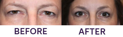 Endoscopic Brow Lift & Upper Eyelid Blepharop