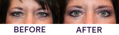 4-Eyelid Blepharoplasty & Internal Brow Lift