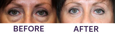 Lower Eyelid Blepharoplasty