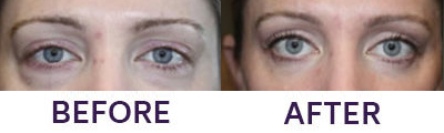 Lower Eyelid Blepharoplasty