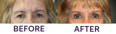 Pretrichial Browplasty/Bilateral Upper Lift