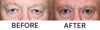 Ptosis Repair, Eyelid Blepharoplasty & Intern