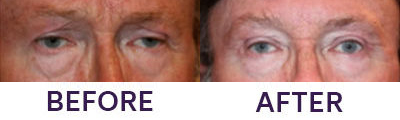 Ptosis Repair, Eyelid Blepharoplasty & Intern