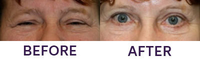 Ptosis Repair, Eyelid Blepharoplasty & Intern