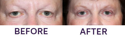 Ptosis Repair, Eyelid Blepharoplasty & Intern