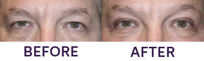 Upper Eyelid Blepharoplasty & Internal Brow Lift
