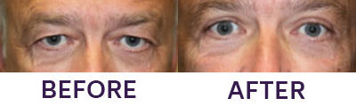 Upper Eyelid Blepharoplasty & Internal Brow Lift