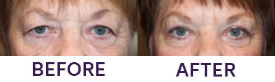 Upper Eyelid Blepharoplasty & Internal Brow Lift