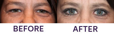 Upper Eyelid Blepharoplasty & Internal Brow Lift