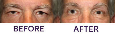 Upper Eyelid Blepharoplasty & Internal Brow Lift
