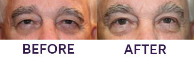 Upper Eyelid Blepharoplasty & Internal Brow Lift