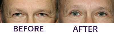 Upper Eyelid Blepharoplasty
