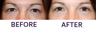 Upper Eyelid Blepharoplasty