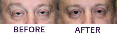 Upper Eyelid Blepharoplasty & Ptosis Repair