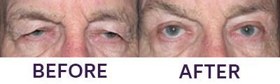 Upper Eyelid Blepharoplasty & Ptosis Repair