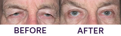 Upper Eyelid Blepharoplasty & Ptosis Repair