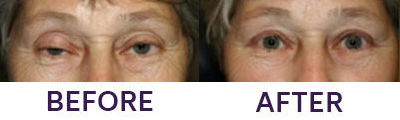 Upper Eyelid Blepharoplasty & Ptosis Repair