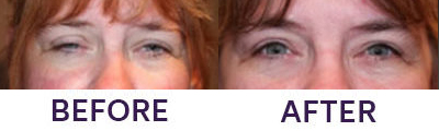 Upper Eyelid Blepharoplasty & Ptosis Repair