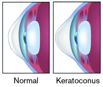 Normal Eye compared to Keratoconus Eye